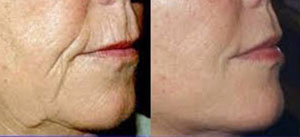 Jalupro and Profhilo before after-