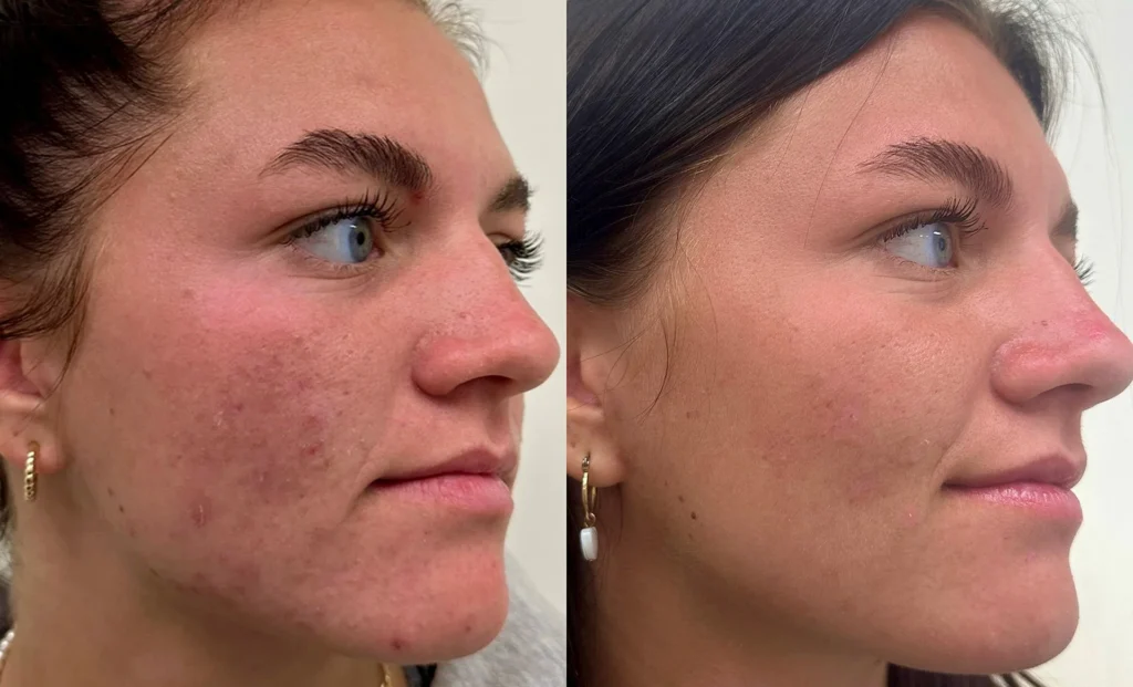 Micro needling , Jumeirah
